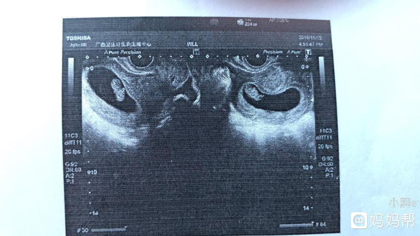做供卵试管婴儿有5大流程，想生孩子的不孕不育姐妹们要注意收集