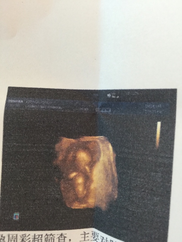 赠卵试管婴儿取卵后，我的月经会提前或推迟吗？