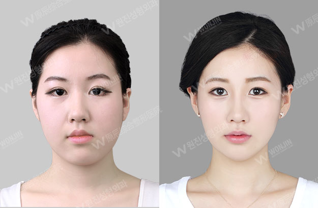 惠州借卵试管婴儿的成功率高吗？惠州国际客户的实际案例告诉你