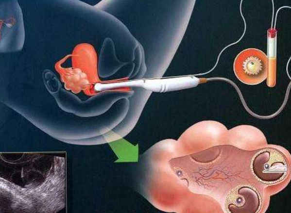 做供卵试管婴儿每代的价格