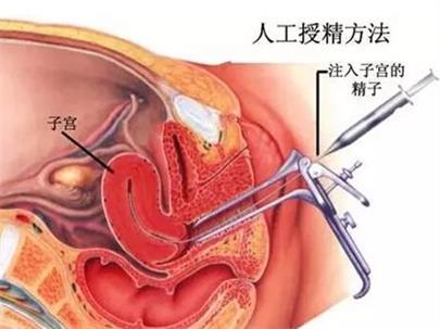 广州市可以做供卵试管婴儿的医院