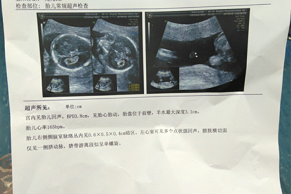 广州送子鸟供卵做试管费用是多少
