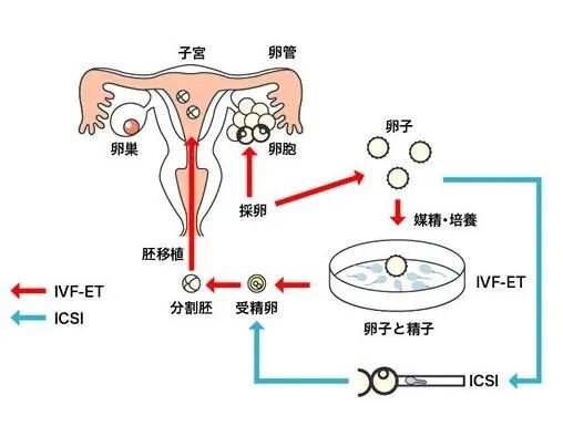 复合移植试管婴儿成功率高吗