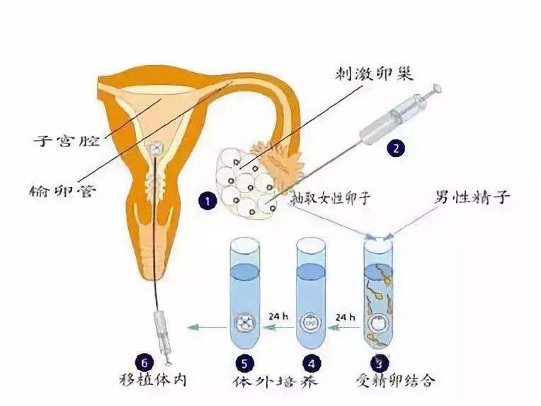 广州试管怎么移植免费预定机票及住宿安排
