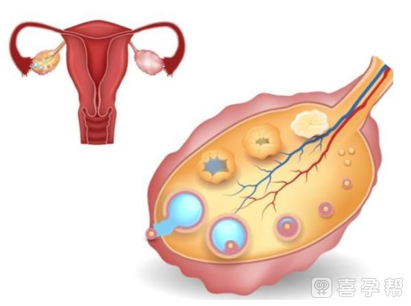 专家解答得了子宫腺肌症能通过正规医院供卵怀孕吗